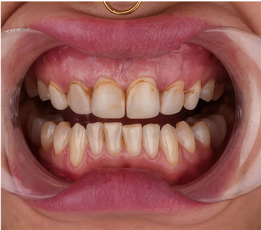 Hollywood Smile
