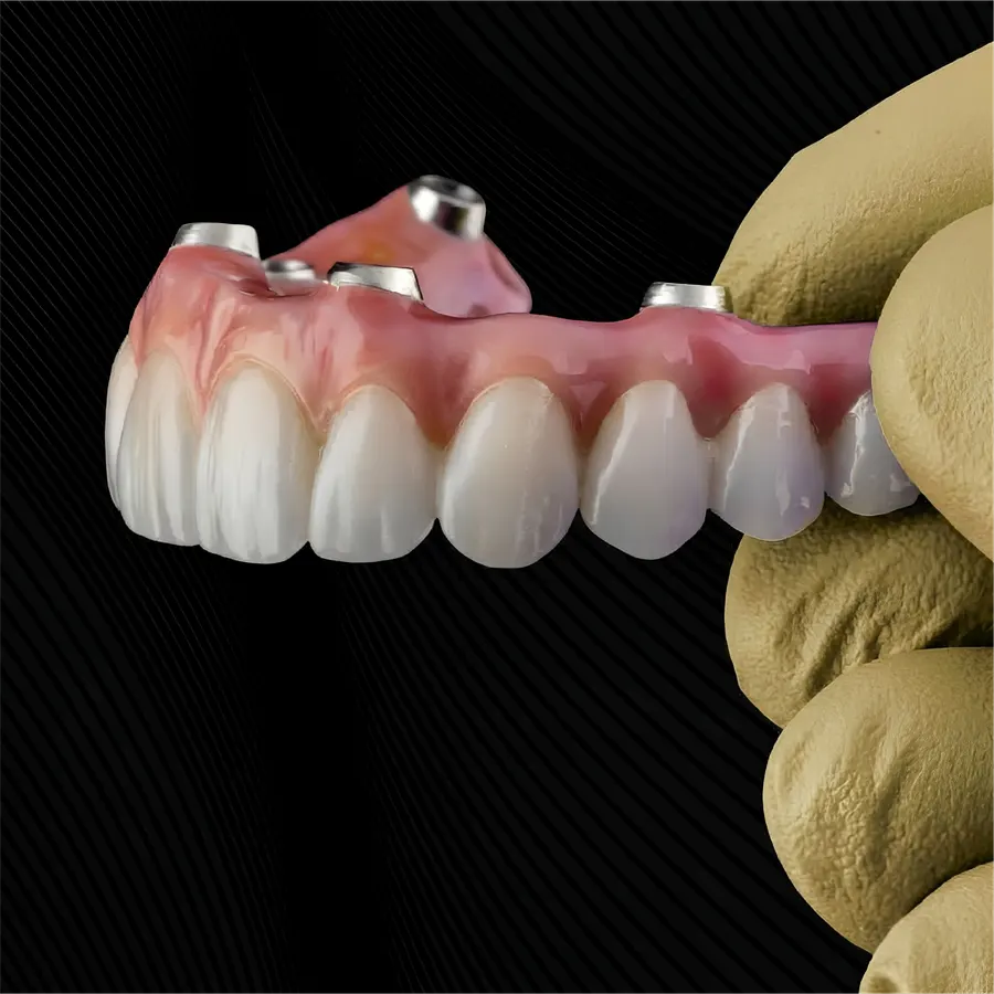 All-on-X full-arch restoration on implants