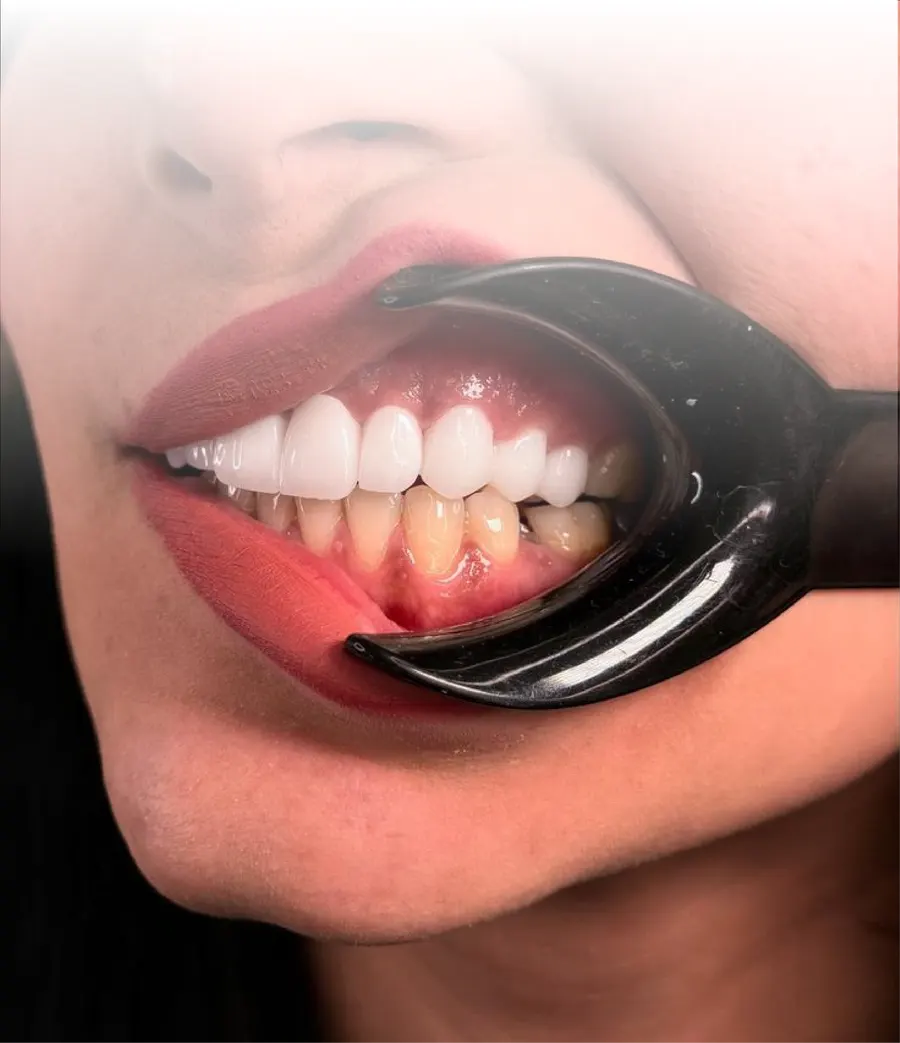 BEYOND teeth whitening